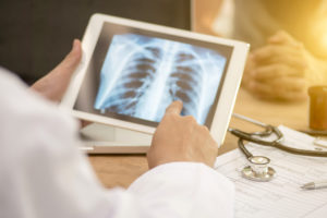 istockphoto Dr xray 874793162 300x200 - doctor looking at x-ray of lungs and writing diagnosis