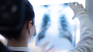 AdobeStock 419956910 edited 300x169 - Pulmonologist looking at lung x-ray prescribing treatment to patient, healthcare